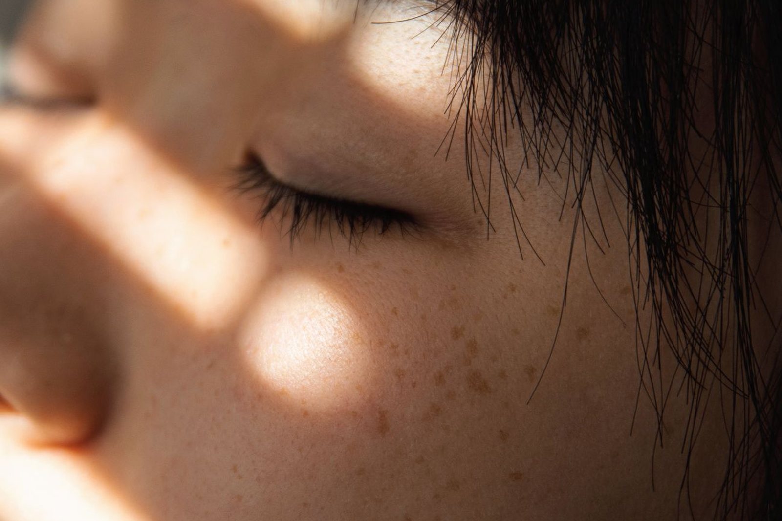Why melasma doesn't respond to a stronger peel