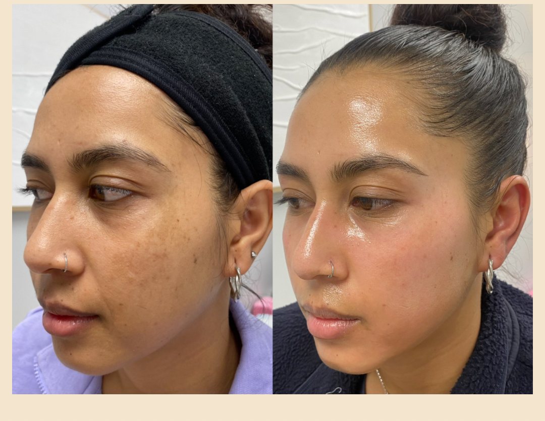 Client skin before and after a Cosmelan depigmentation program