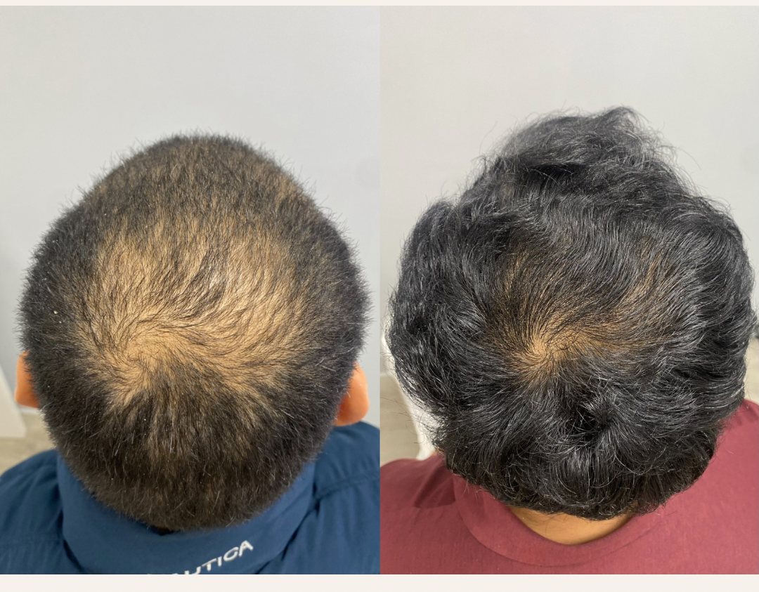Client scalp before and after PRF hair restoration