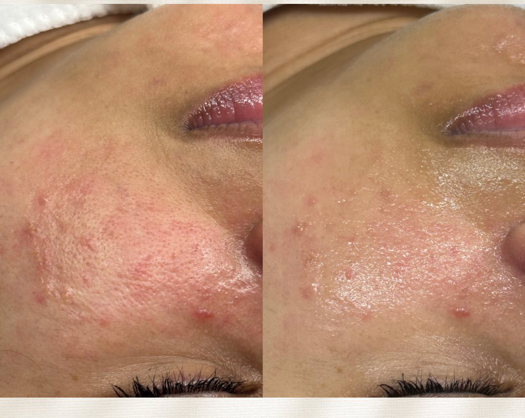 Client skin before and after a Signature Recovery Facial