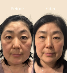 Before and after one session of PRP EzFill Bio Filler, photographed three weeks after treatment, shared with client consent
