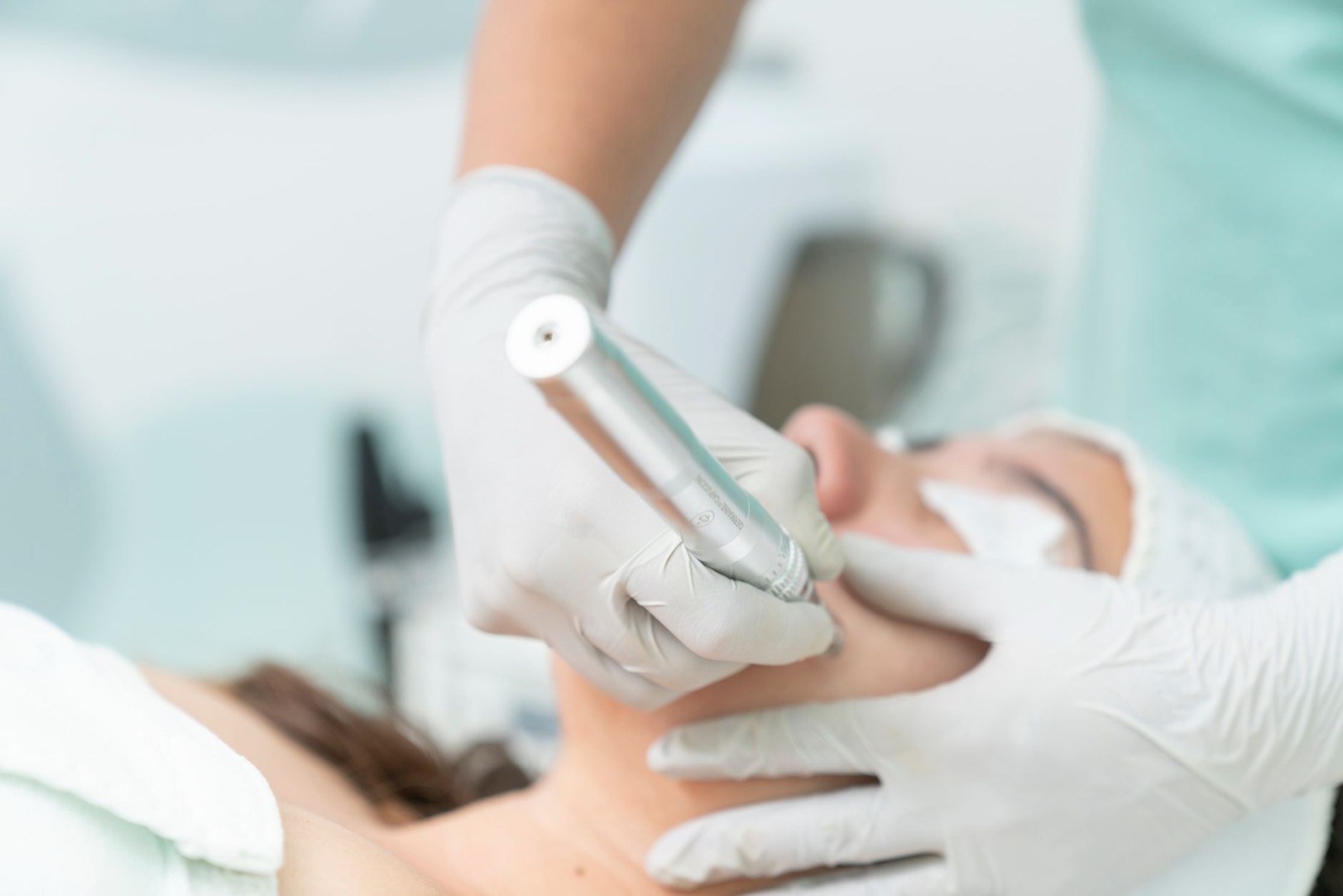 Microneedling skin treatment in progress