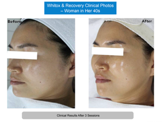 Whitox manufacturer clinical photos, woman in her 40s, before and after three sessions
