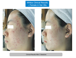 Whitox manufacturer clinical photos, woman in her 30s, before and after three sessions