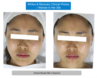 Whitox manufacturer clinical photos, woman in her 30s, before and after four sessions