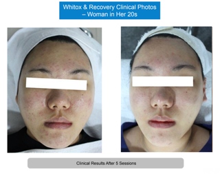 Whitox manufacturer clinical photos, woman in her 20s, before and after five sessions